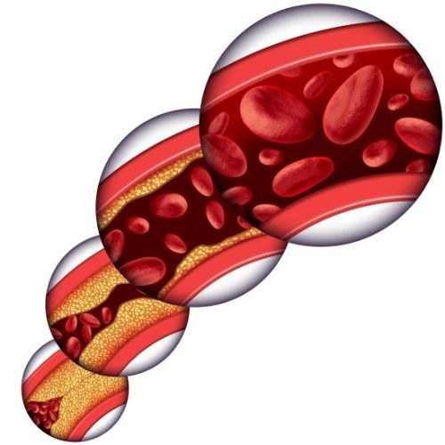 Tukové usazeniny (plak) v tepnách při vysokém LDL cholesterolu